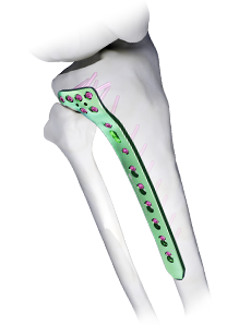 Implants Orthopédiques