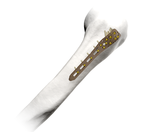 L’artisanat indien – Une référence mondiale en soins orthopédiques