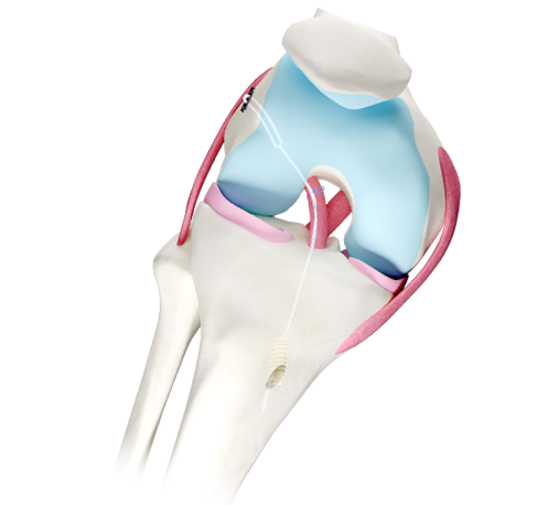 Quand chaque os compte, la précision est essentielle !