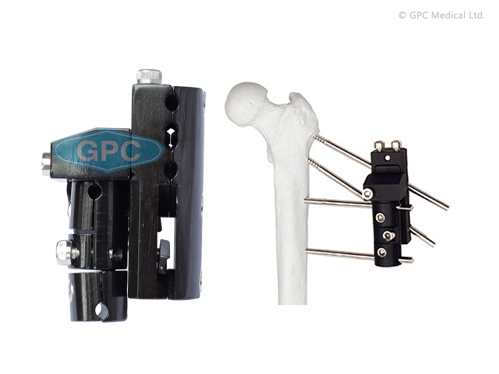 Fixateur pertrochantérien 