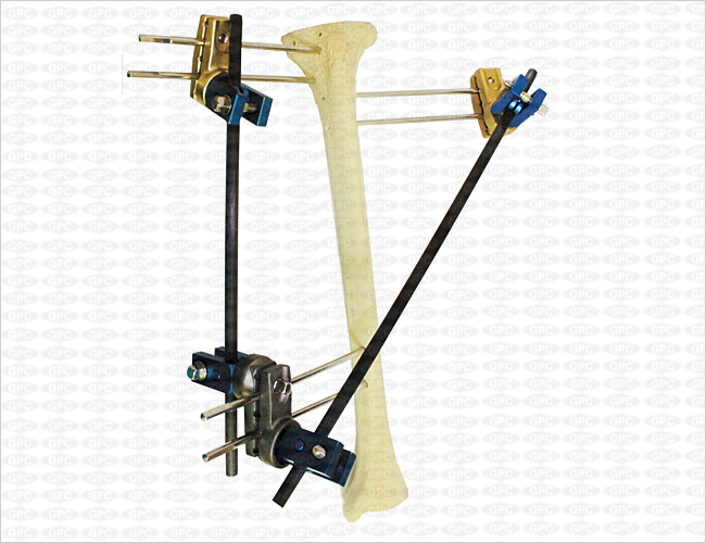 Tibia Compound Fracture Fixation
